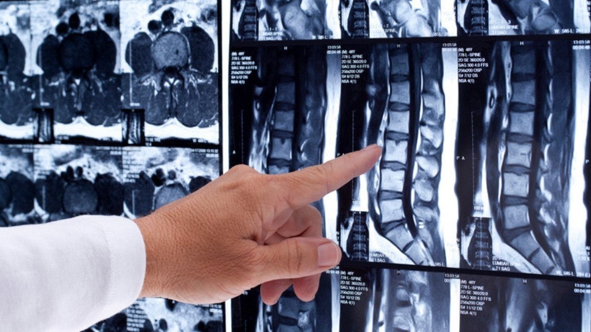 A finger points to a spine on MRI film, the kind of imaging catastrophic injury attorneys in Summerville review in spinal cord cases